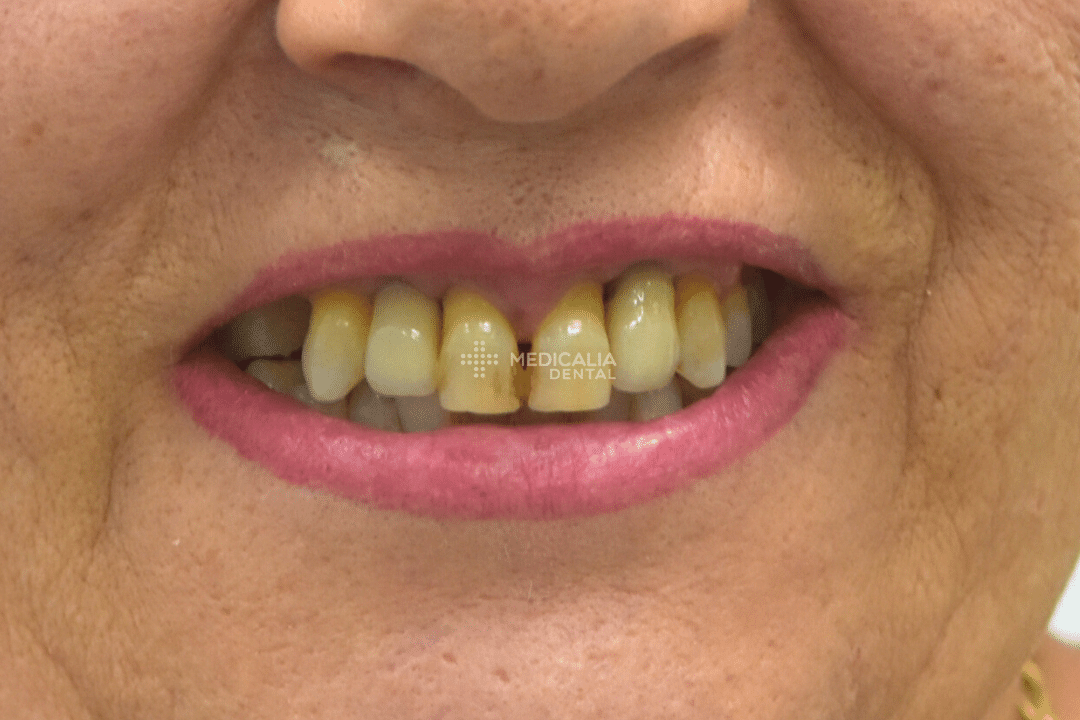 Caso real antes y después de tratamiento dental en Medicalia Fuenlabrada 10