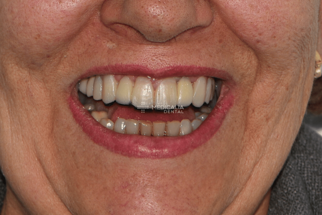 Caso real antes y después de tratamiento dental en Medicalia Fuenlabrada 9