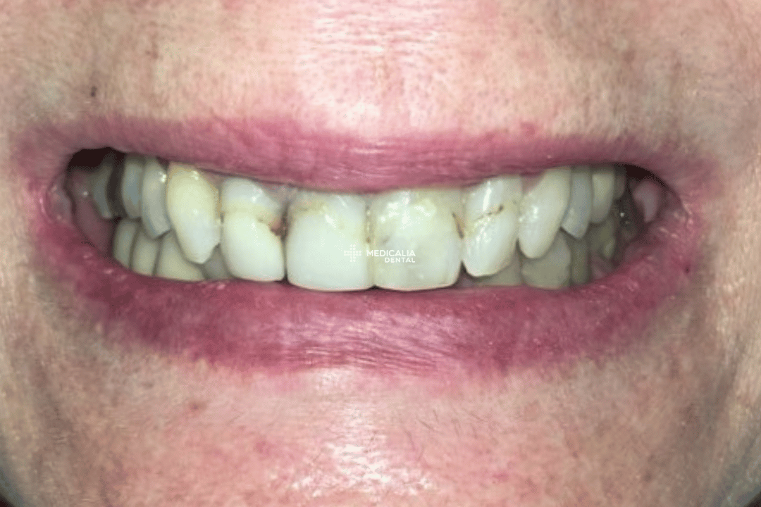 Caso real antes y después de tratamiento dental en Medicalia Fuenlabrada 11