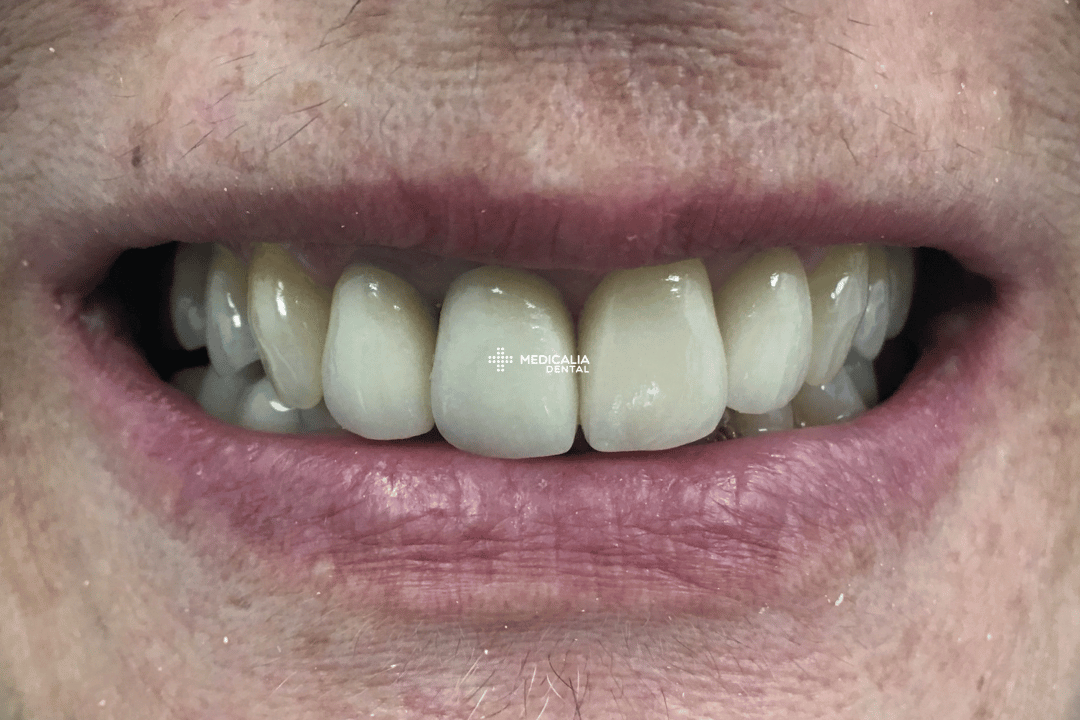 Caso real antes y después de tratamiento dental en Medicalia Fuenlabrada 12