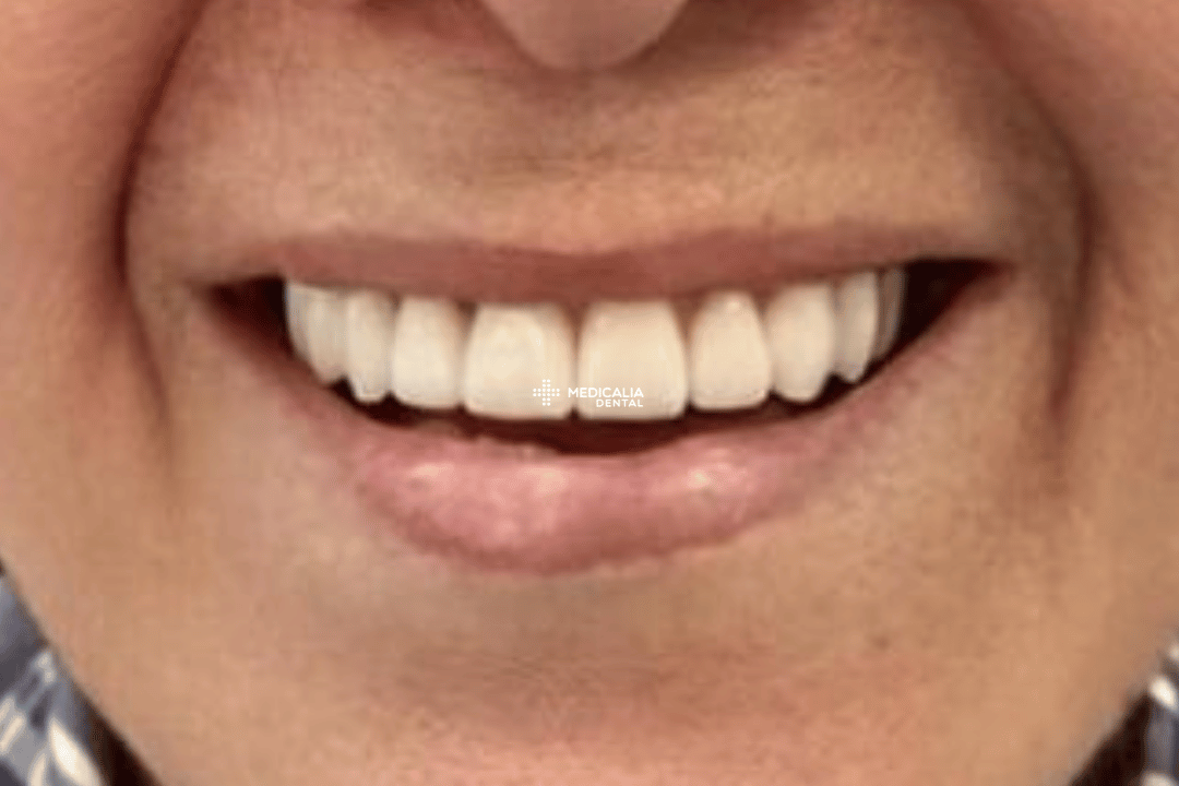 Caso real antes y después de tratamiento dental en Medicalia Fuenlabrada 13
