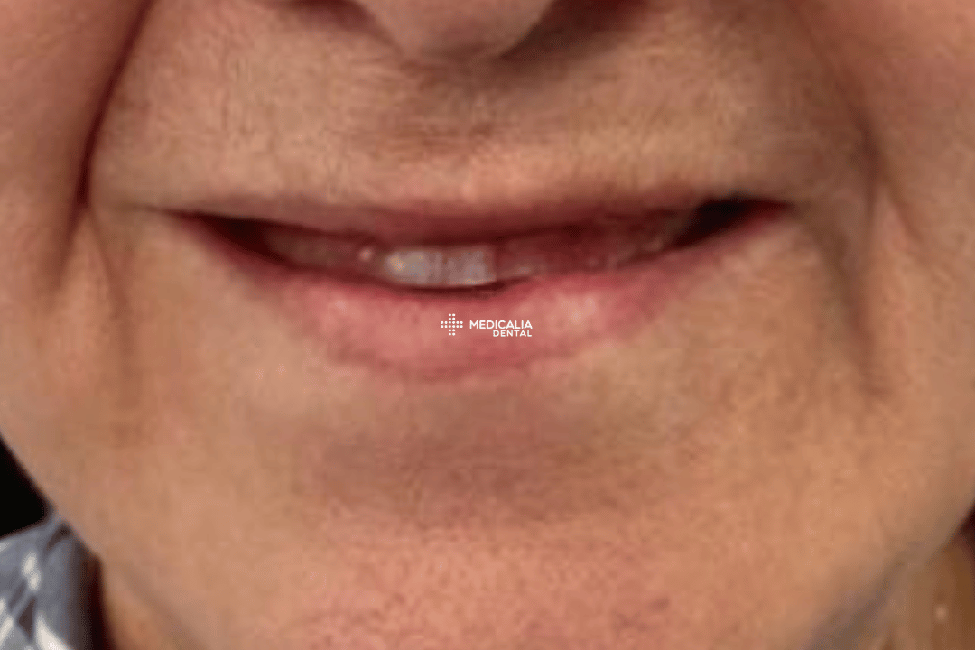Caso real antes y después de tratamiento dental en Medicalia Fuenlabrada 14