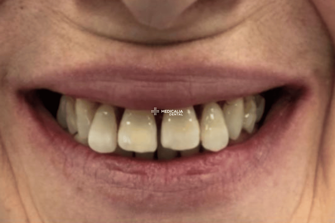 Caso real antes y después de tratamiento dental en Medicalia Fuenlabrada 15