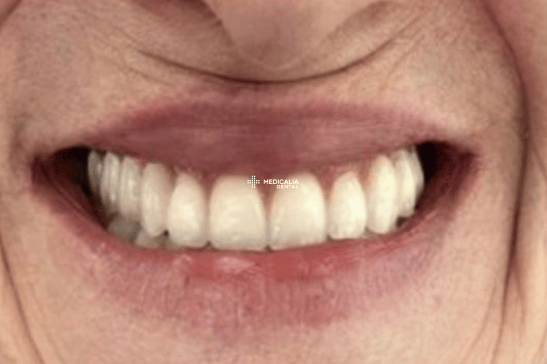 Caso real antes y después de tratamiento dental en Medicalia Fuenlabrada 16