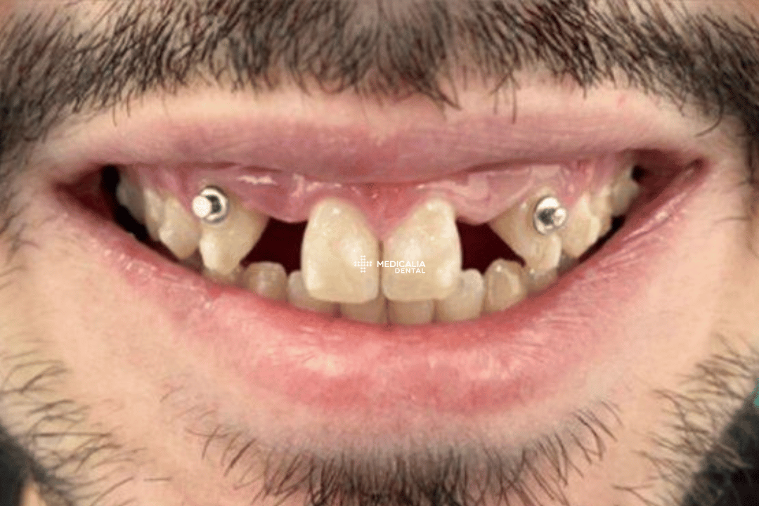 Caso real antes y después de tratamiento dental en Medicalia Fuenlabrada 17
