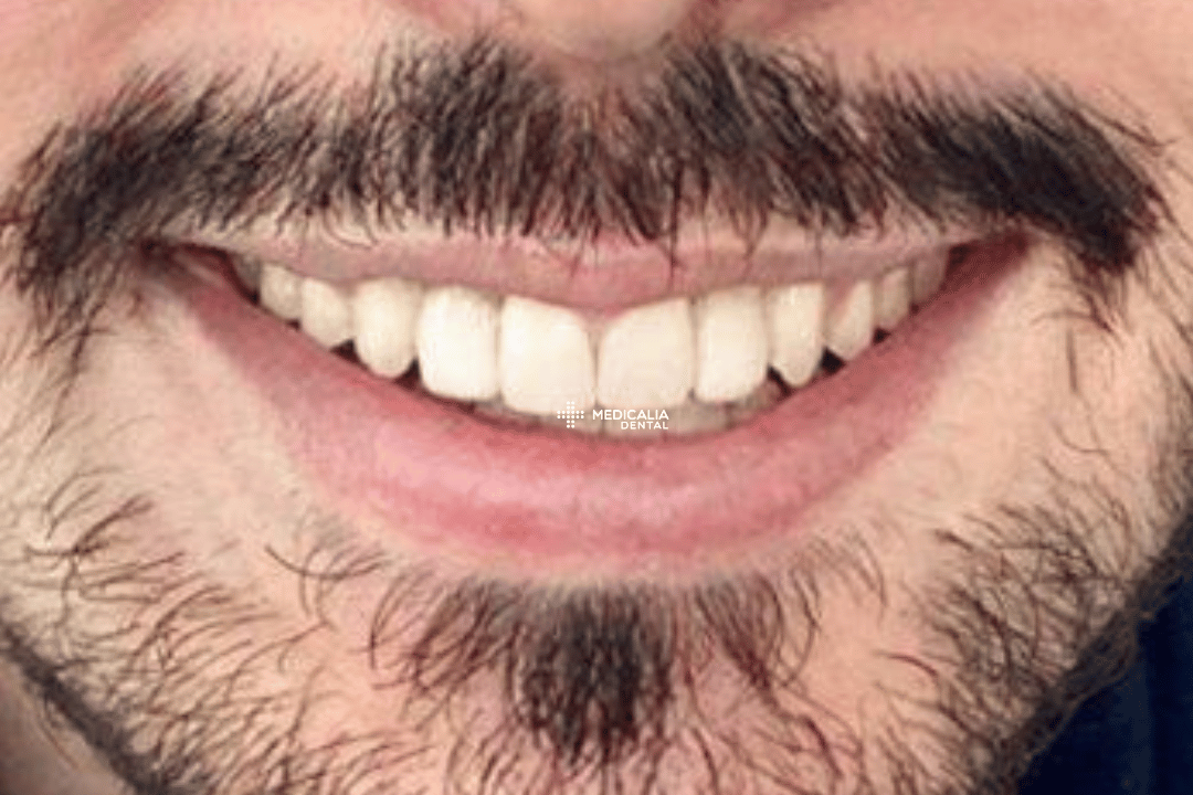 Caso real antes y después de tratamiento dental en Medicalia Fuenlabrada 18