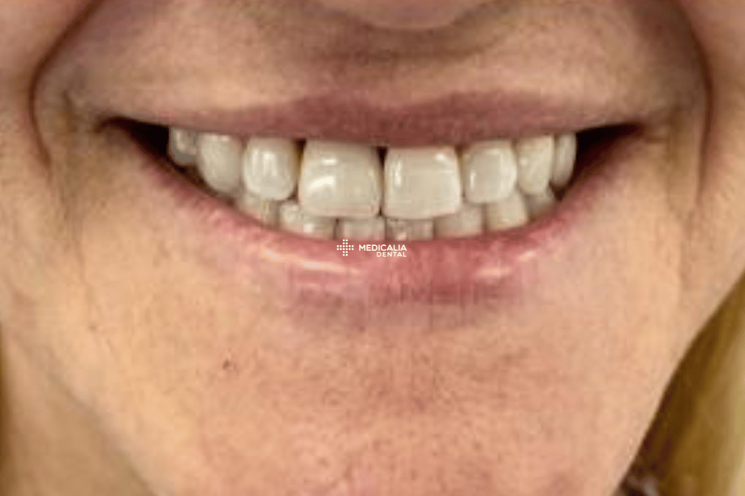 Caso real antes y después de tratamiento dental en Medicalia Fuenlabrada 19