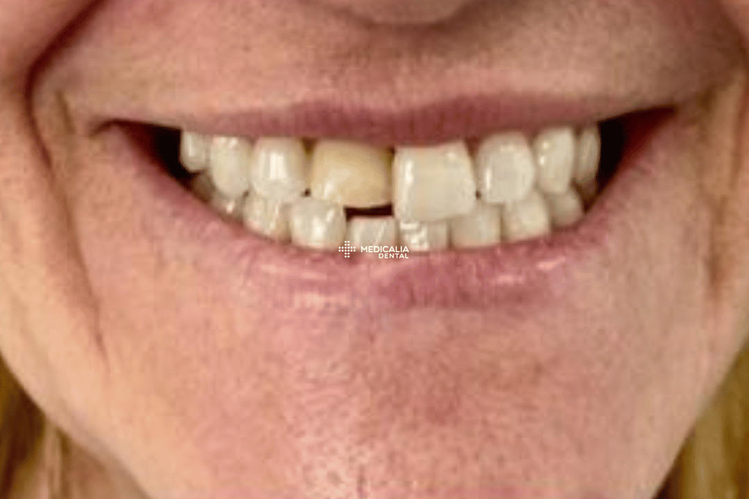 Caso real antes y después de tratamiento dental en Medicalia Fuenlabrada 20
