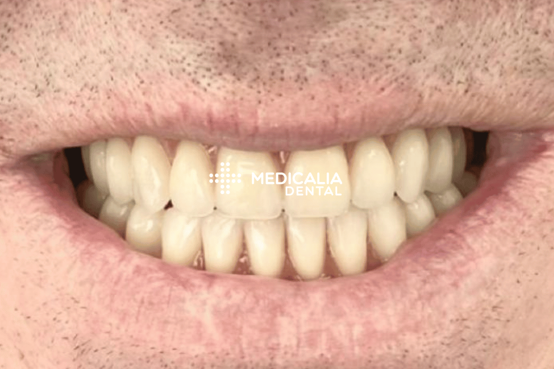 Caso real antes y después de tratamiento dental en Medicalia Fuenlabrada 21