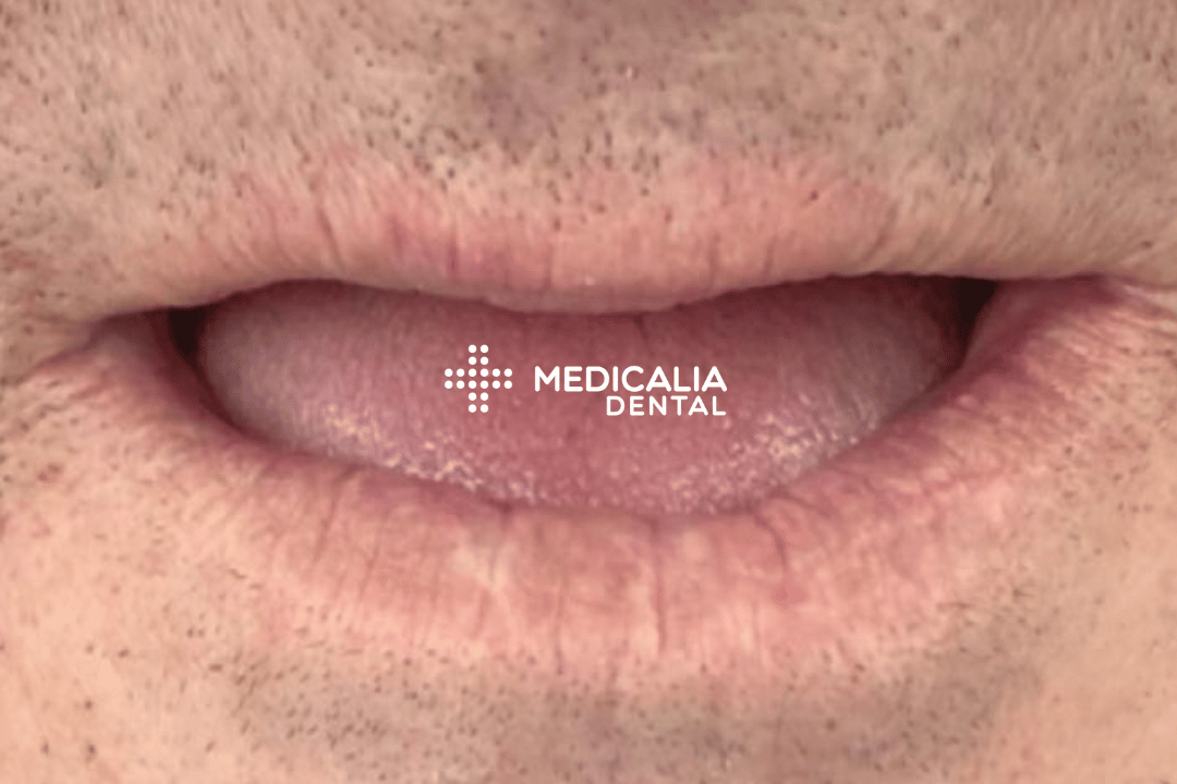 Caso real antes y después de tratamiento dental en Medicalia Fuenlabrada 22