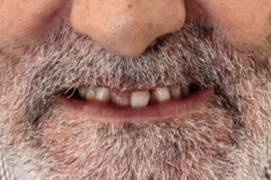 Caso real antes y después de tratamiento dental en Medicalia Fuenlabrada 23