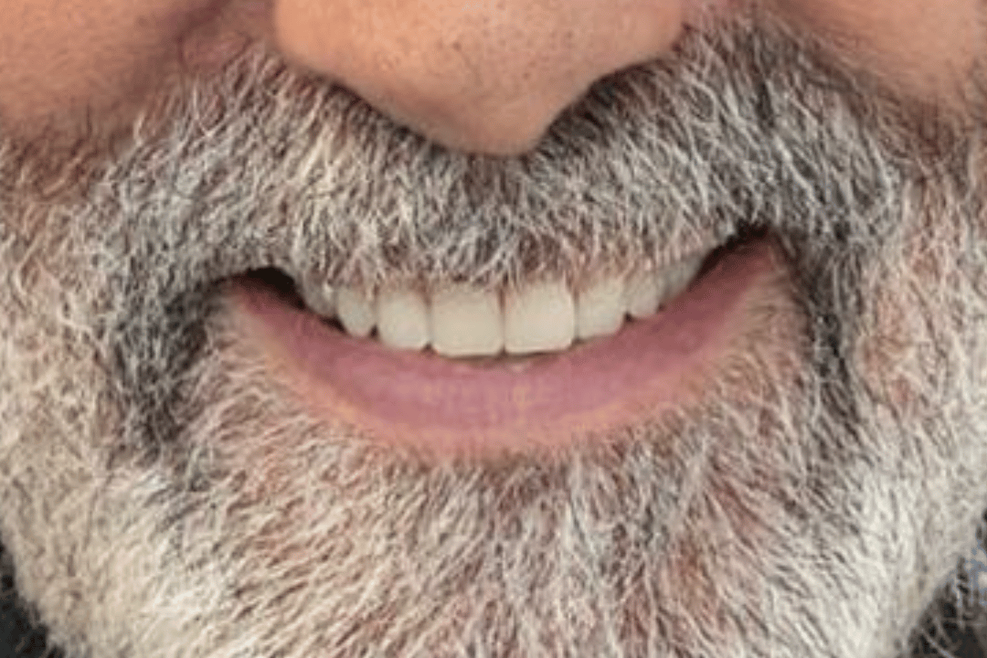 Caso real antes y después de tratamiento dental en Medicalia Fuenlabrada 24